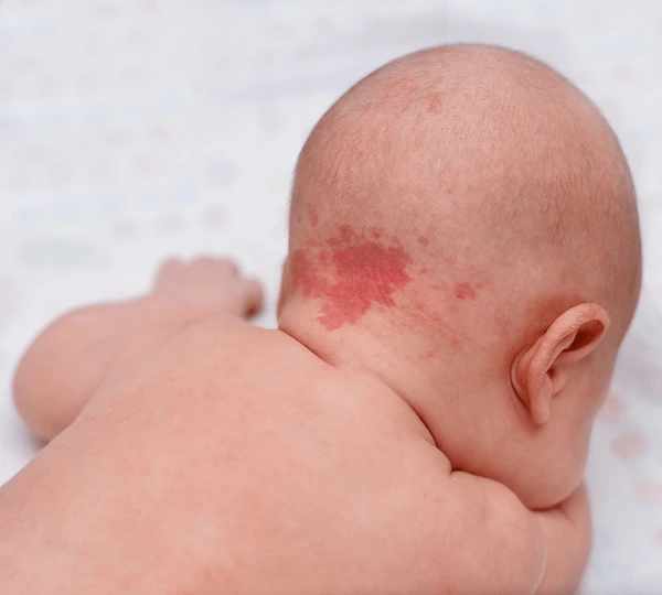 Strawberry Birthmark Spiritual Meaning: Love and Connection