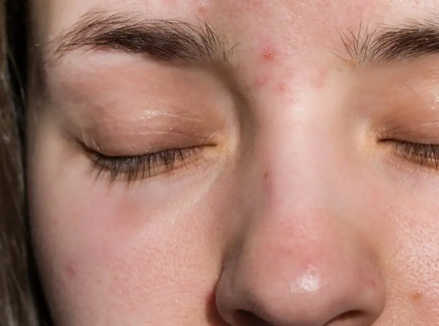 Pimple Between the Eyebrows: Possible Spiritual Meanings
